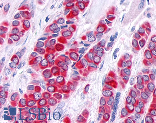 Anti-TNIK antibody IHC of human Breast, Carcinoma. Immunohistochemistry of formalin-fixed, paraffin-embedded tissue after heat-induced antigen retrieval.