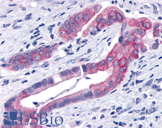 Anti-TNIK antibody IHC of human Pancreas, Carcinoma. Immunohistochemistry of formalin-fixed, paraffin-embedded tissue after heat-induced antigen retrieval.