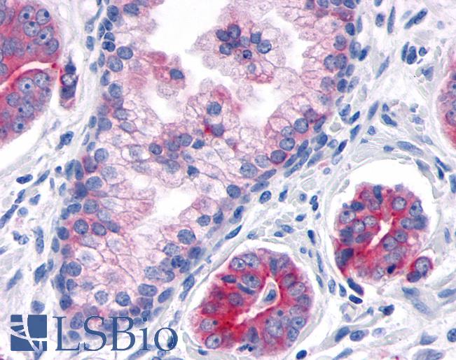 Anti-TNIK antibody IHC of human Prostate, Carcinoma. Immunohistochemistry of formalin-fixed, paraffin-embedded tissue after heat-induced antigen retrieval.