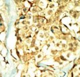 Formalin-fixed and paraffin-embedded human cancer tissue reacted with the primary antibody, which was peroxidase-conjugated to the secondary antibody, followed by DAB staining. This data demonstrates the use of this antibody for immunohistochemistry; clinical relevance has not been evaluated. BC = breast carcinoma; HC = hepatocarcinoma.