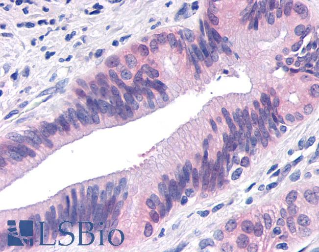 Anti-TNIK antibody IHC of human Pancreas, Carcinoma. Immunohistochemistry of formalin-fixed, paraffin-embedded tissue after heat-induced antigen retrieval.