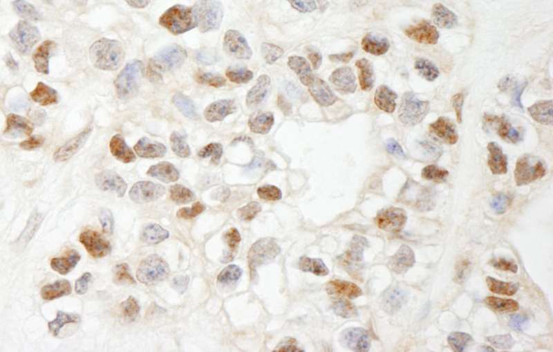 Detection of Human MCAF by Immunohistochemistry. Sample: FFPE section of human breast carcinoma. Antibody: Affinity purified rabbit anti-MCAF used at a dilution of 1:1000 (1 Detection: DAB.