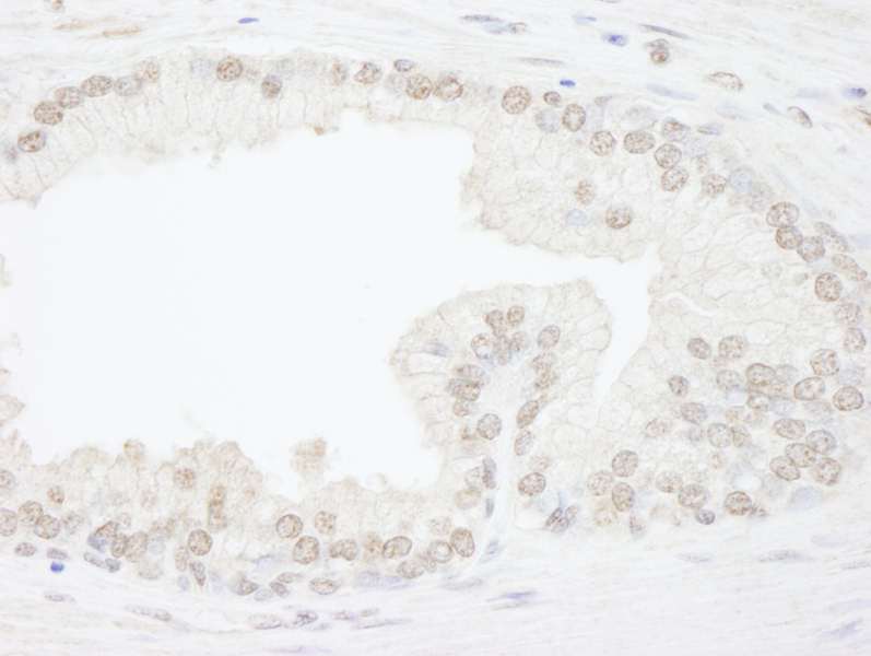 Detection of Human ATRX by Immunohistochemistry. Sample: FFPE section of human prostate carcinoma. Antibody: Affinity purified rabbit anti-ATRX used at a dilution of 1:1000 (1 ug/ml).