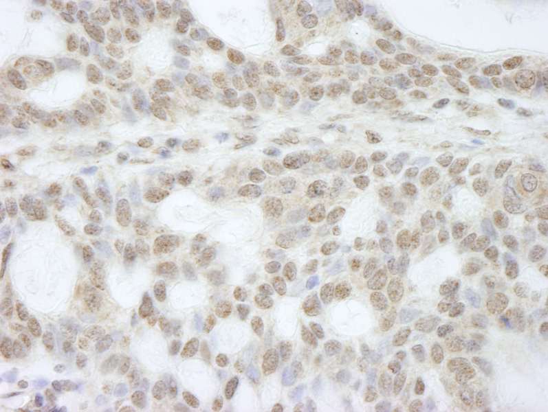 Detection of Human ATRX by Immunohistochemistry. Sample: FFPE section of human basal cell carcinoma. Antibody: Affinity purified rabbit anti-ATRX used at a dilution of 1:250.