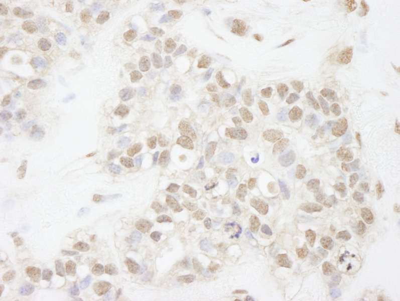 Detection of Human ATRX by Immunohistochemistry. Sample: FFPE section of human breast carcinoma. Antibody: Affinity purified rabbit anti-ATRX used at a dilution of 1:250.