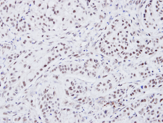 IHC of paraffin-embedded A549 xenograft using ATRX antibody at 1:100 dilution.