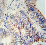 B3GNT6 Antibody immunohistochemistry of formalin-fixed and paraffin-embedded human colon carcinoma followed by peroxidase-conjugated secondary antibody and DAB staining.