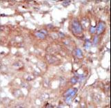 Formalin-fixed and paraffin-embedded human cancer tissue reacted with the primary antibody, which was peroxidase-conjugated to the secondary antibody, followed by AEC staining. This data demonstrates the use of this antibody for immunohistochemistry; clinical relevance has not been evaluated. BC = breast carcinoma; HC = hepatocarcinoma.