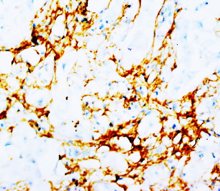 TNN / Tenascin N antibody. IHC(P): Human Breast Cancer Tissue.