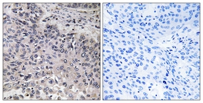 IHC of paraffin-embedded human lung carcinoma tissue, using C1QC Antibody. The picture on the right is treated with the synthesized peptide.