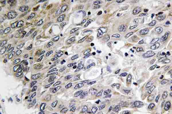 IHC of C1q-C (Q119) pAb in paraffin-embedded human lung carcinoma tissue.