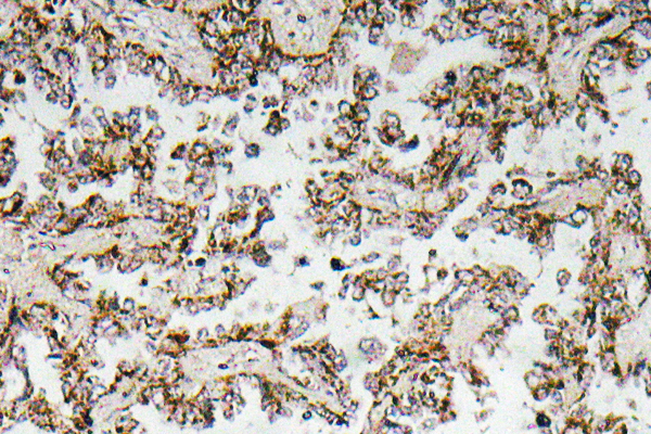 IHC of CRF (R153) pAb in paraffin-embedded human lung carcinoma tissue.