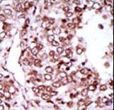 Formalin-fixed and paraffin-embedded human cancer tissue reacted with the primary antibody, which was peroxidase-conjugated to the secondary antibody, followed by AEC staining. This data demonstrates the use of this antibody for immunohistochemistry; clinical relevance has not been evaluated. BC = breast carcinoma; HC = hepatocarcinoma.