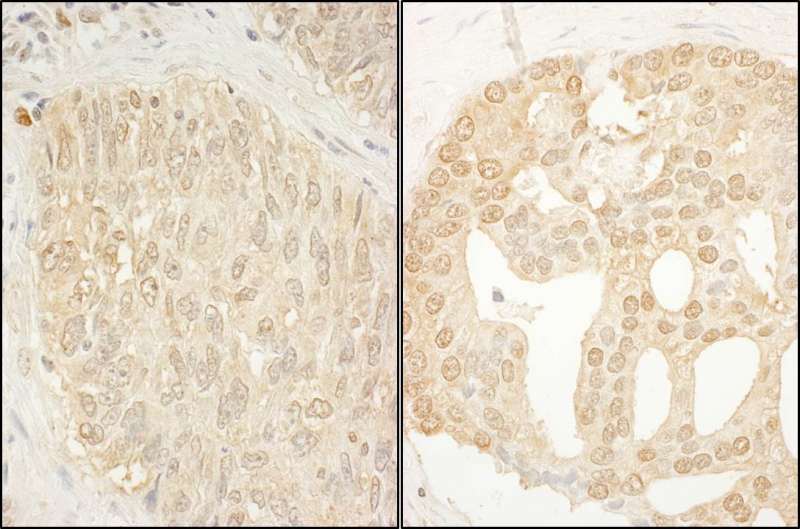 Detection of Human CaMKK alpha by Immunohistochemistry. Sample: FFPE section of human lung carcinoma (left) and human prostate carcinoma (right). Antibody: Affinity purified rabbit anti-CaMKK alpha used at a dilution of 1:1000 (1 ug/ml). Detection: DAB.