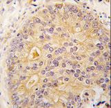 Formalin-fixed and paraffin-embedded human prostate carcinoma tissue reacted with CAMKK2 antibody , which was peroxidase-conjugated to the secondary antibody, followed by DAB staining. This data demonstrates the use of this antibody for immunohistochemistry; clinical relevance has not been evaluated.
