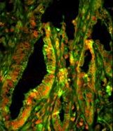 Immunofluorescence of CAPZA1 Antibody with paraffin-embedded human prostate carcinoma tissue. 0.05 mg/ml primary antibody was followed by FITC-conjugated goat anti-rabbit lgG (whole molecule). FITC emits green fluorescence.Red counterstaining is PI.