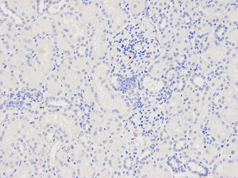 Immunohistochemistry of paraffin-embedded human lung cancer using CAPZA2 antibody at dilution of 1:200 (400x lens).