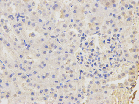 Immunohistochemistry of paraffin-embedded human breast cancer using CAPZA2 antibody at dilution of 1:200 (400x lens).