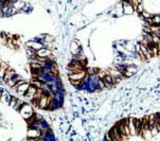 IHC of LI-Cadherin on FFPE Colon Carcinoma tissue.