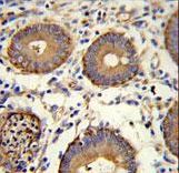 CEA Antibody immunohistochemistry of formalin-fixed and paraffin-embedded human colon carcinoma followed by peroxidase-conjugated secondary antibody and DAB staining.
