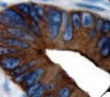 IHC of CEA on FFPE Colon Adenocarcinoma tissue.