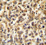 CCDC19 Antibody immunohistochemistry of formalin-fixed and paraffin-embedded human testis carcinoma followed by peroxidase-conjugated secondary antibody and DAB staining.