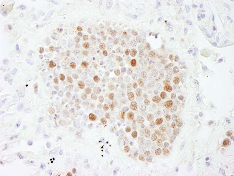 Detection of Human CAF-1 p60 by Immunohistochemistry. Sample: FFPE section of human small cell lung cancer. Antibody: Affinity purified rabbit anti-CAF-1 p60 used at a dilution of 1:200 (1 ug/ml).