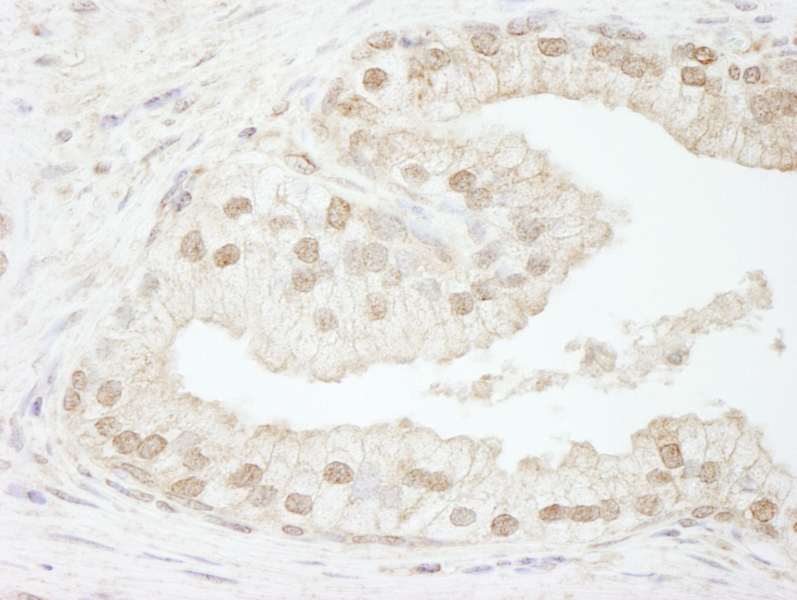 Detection of Human CAF-1 p60 by Immunohistochemistry. Sample: FFPE section of human prostate carcinoma. Antibody: Affinity purified rabbit anti-CAF-1 p60 used at a dilution of 1:250.