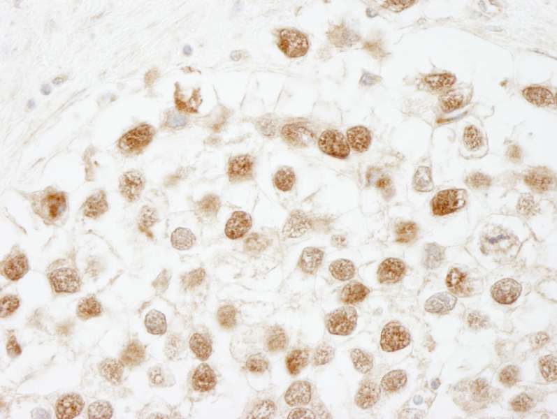Detection of Human CAF-1 p60 by Immunohistochemistry. Sample: FFPE section of human seminoma. Antibody: Affinity purified rabbit anti-CAF-1 p60 used at a dilution of 1:250.