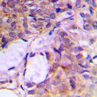 Immunohistochemical analysis of CNK2 staining in human breast cancer formalin fixed paraffin embedded tissue section. The section was pre-treated using heat mediated antigen retrieval with sodium citrate buffer (pH 6.0). The section was then incubated with the antibody at room temperature and detected using an HRP conjugated compact polymer system. DAB was used as the chromogen. The section was then counterstained with hematoxylin and mounted with DPX. w