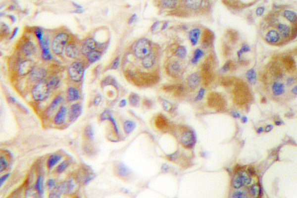 IHC of Collagen I (S3) pAb in paraffin-embedded human breast carcinoma tissue.