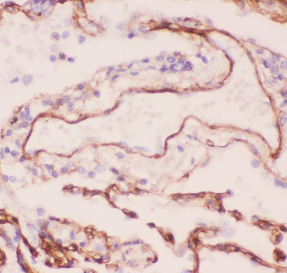 Collagen IV antibody IHC-paraffin: Human Lung Cancer Tissue.