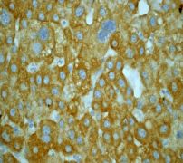 IHC of paraffin-embedded human liver carcinoma using anti-DAPK2 antibody.