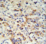 DCT Antibody IHC of formalin-fixed and paraffin-embedded breast carcinoma followed by peroxidase-conjugated secondary antibody and DAB staining.