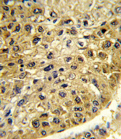 Formalin-fixed and paraffin-embedded human hepatocarcinoma reacted with DCT Antibody , which was peroxidase-conjugated to the secondary antibody, followed by DAB staining. This data demonstrates the use of this antibody for immunohistochemistry; clinical relevance has not been evaluated.