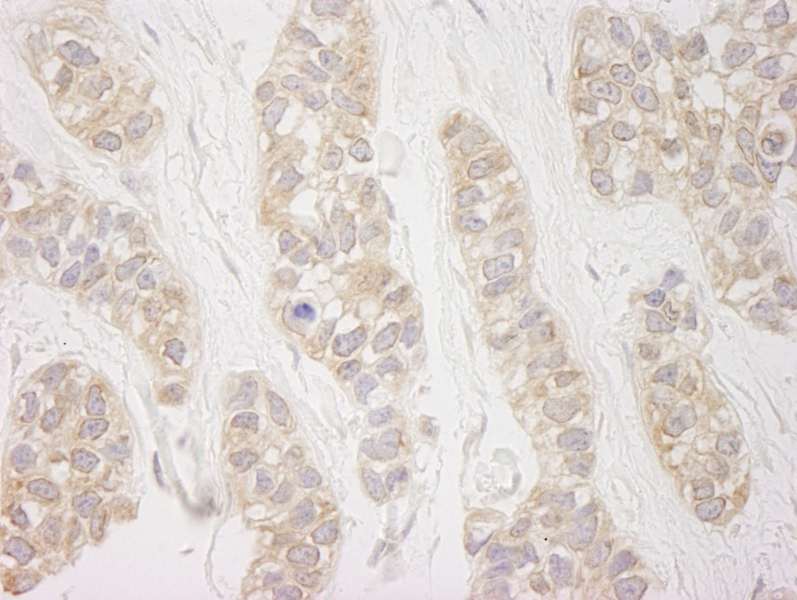 Detection of Human DDX19 by Immunohistochemistry. Sample: FFPE section of human breast carcinoma. Antibody: Affinity purified rabbit anti-DDX19 used at a dilution of 1:250. Epitope Retrieval Buffer-High pH (IHC-101J) was substituted for Epitope Retrieval Buffer-Reduced pH.