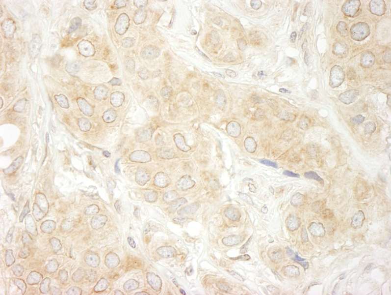 Detection of Human DDX19 by Immunohistochemistry. Sample: FFPE section of human breast carcinoma. Antibody: Affinity purified rabbit anti-DDX19 used at a dilution of 1:200 (1 ug/ml). Detection: DAB.