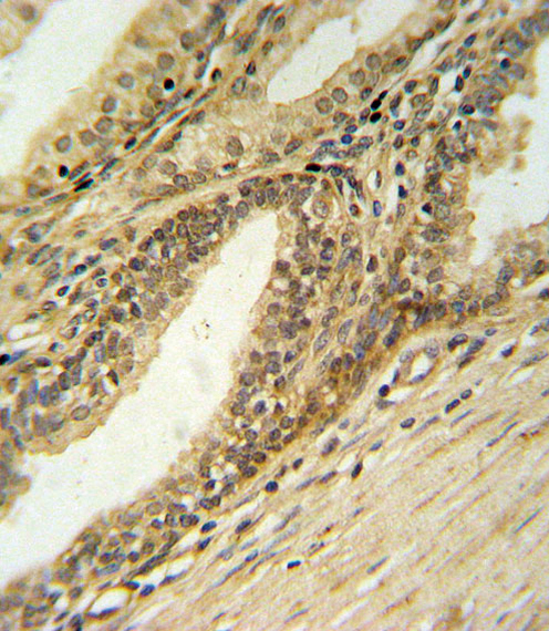 DFFB Antibody IHC of formalin-fixed and paraffin-embedded prostate carcinoma followed by peroxidase-conjugated secondary antibody and DAB staining.