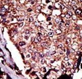 Formalin-fixed and paraffin-embedded human cancer tissue reacted with the primary antibody, which was peroxidase-conjugated to the secondary antibody, followed by DAB staining. This data demonstrates the use of this antibody for immunohistochemistry; clinical relevance has not been evaluated. BC = breast carcinoma; HC = hepatocarcinoma.