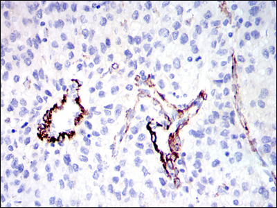 IHC of paraffin-embedded human liver cancer tissues using GKAP mouse monoclonal antibody with DAB staining.