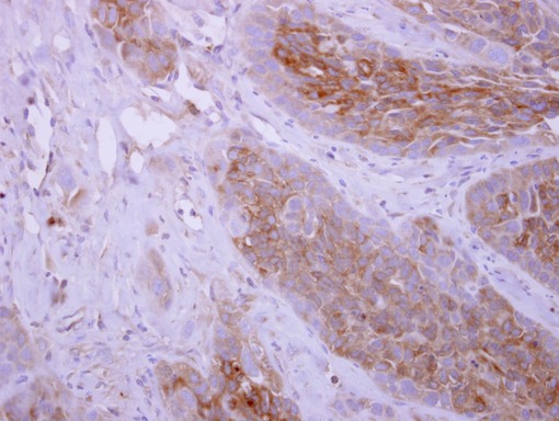 DPYD antibody [N1N2], N-term detects DPYD protein at cytoplasm on H358 xenograft by immunohistochemical analysis. Sample: Paraffin-embedded H358 xenograft. DPYD antibody [N1N2], N-term dilution:1:500.