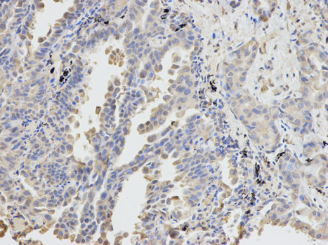 Immunohistochemistry of paraffin-embedded human lung cancer using DPYD antibody at dilution of 1:100 (200x lens).