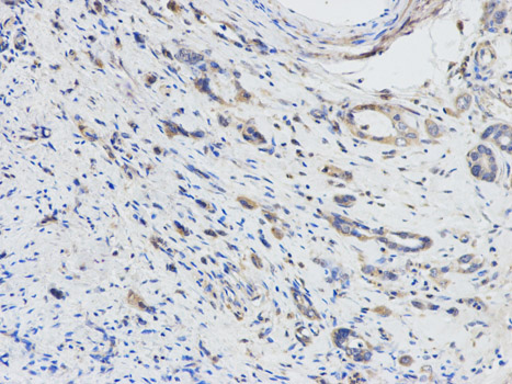 Immunohistochemistry of paraffin-embedded human stomach cancer using DPYD antibody at dilution of 1:100 (200x lens).
