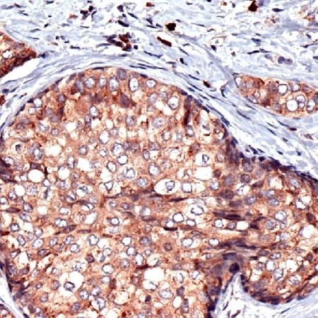 Human breast carcinoma stained with Anti-RCAS1