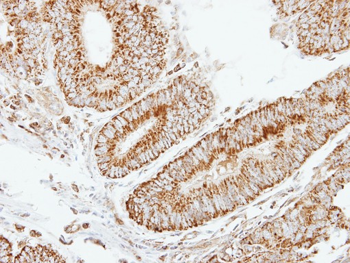 IHC of paraffin-embedded Colon ca using EIF2B beta antibody at 1:250 dilution.