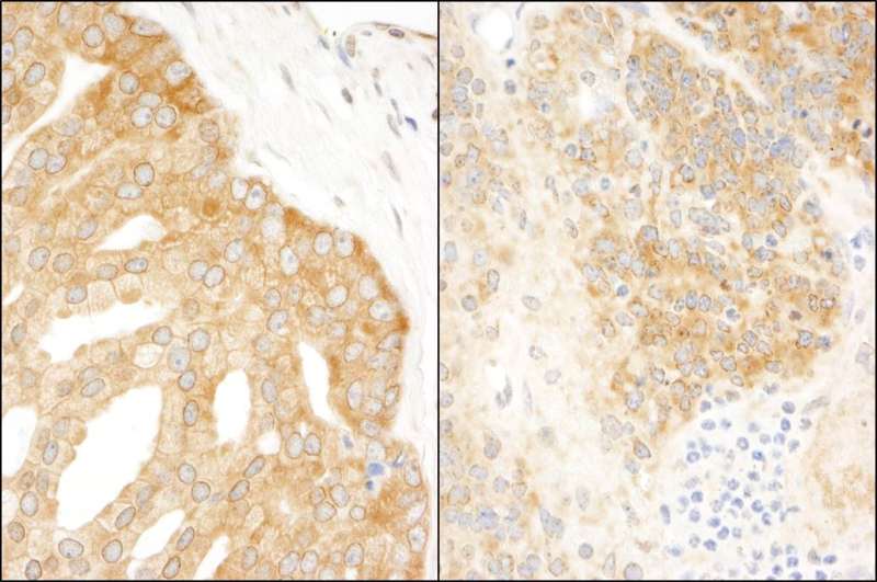 Detection of Human and Mouse eIF3A/EIF3S10 by Immunohistochemistry. Sample: FFPE section of human prostate carcinoma (left) and mouse teratoma (right). Antibody: Affinity purified rabbit anti-eIF3A/EIF3S10 used at a dilution of 1:200 (1 Detection: DAB.