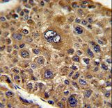 Formalin-fixed and paraffin-embedded human hepatocarcinoma reacted with TOB1 Antibody , which was peroxidase-conjugated to the secondary antibody, followed by DAB staining. This data demonstrates the use of this antibody for immunohistochemistry; clinical relevance has not been evaluated.