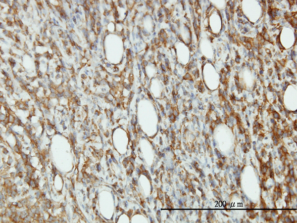 Immunoperoxidase of monoclonal antibody to EIF5 on formalin-fixed paraffin-embedded human malignant lymphoma, diffuse large B tissue. [antibody concentration 1 ug/ml].