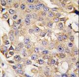 Formalin-fixed and paraffin-embedded human breast carcinoma tissue reacted with ERK1 antibody , which was peroxidase-conjugated to the secondary antibody, followed by DAB staining. This data demonstrates the use of this antibody for immunohistochemistry; clinical relevance has not been evaluated.