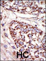 Formalin-fixed and paraffin-embedded human cancer tissue reacted with the primary antibody, which was peroxidase-conjugated to the secondary antibody, followed by DAB staining. This data demonstrates the use of this antibody for immunohistochemistry; clinical relevance has not been evaluated. BC = breast carcinoma; HC = hepatocarcinoma.